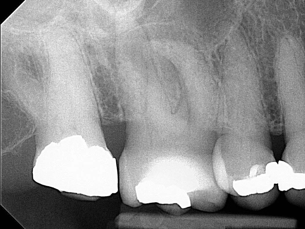 Pre-op PA revealing sclerosed canals on the UR6 and an apical radiolucency on the curved MB root