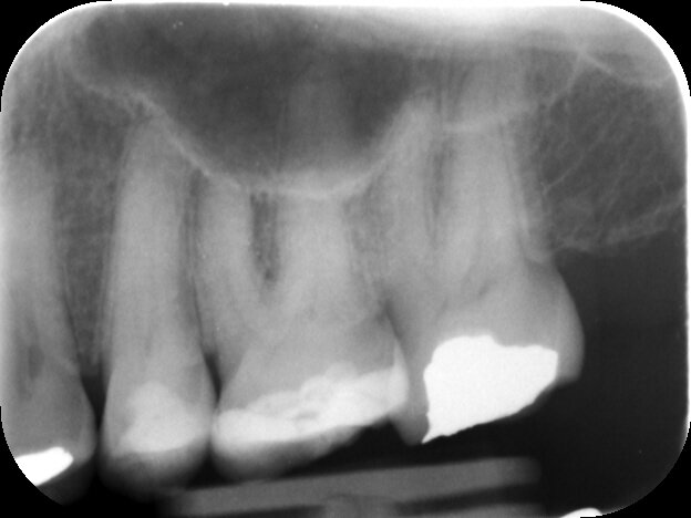 UL7 with recently placed occlusal restoration, pulp calcifications can be seen