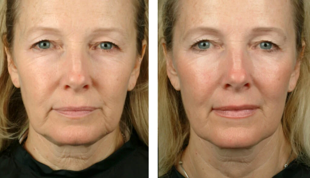 Body Sculpting Center Pittsburgh Therma Lift