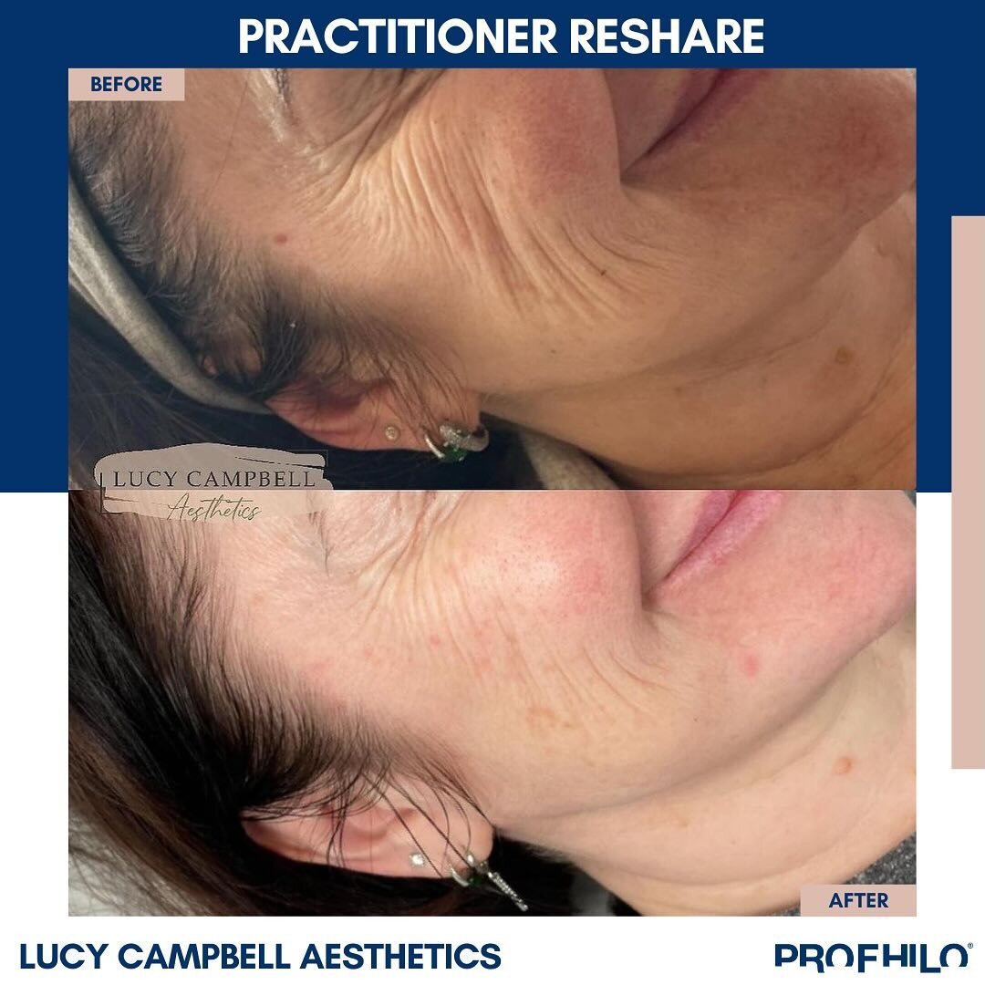 Amazing Profhilo&reg; results by the skilled @lucycampbellaesthetics ✨ the remarkable transformation in skin texture, laxity and quality speaks for itself. 👏

Head to the link in bio to discover the magic of Profhilo&reg; and find a skilled practiti
