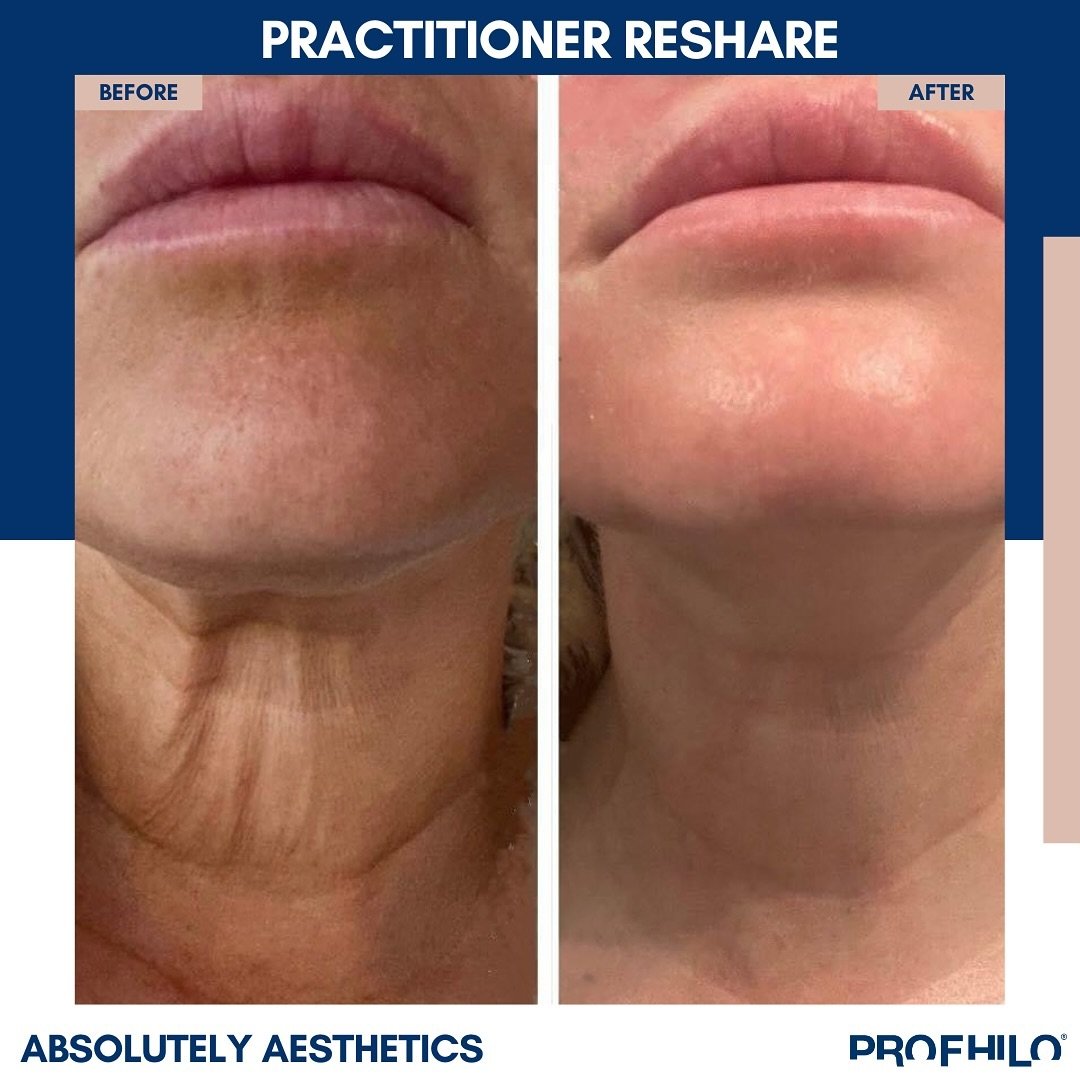 An incredible neck transformation by @absolutelyaesthetics_ ! Experience bioremodeling and enhanced skin laxity for a rejuvenated, confidence-boosting result💉🙌

Head to the link in bio to discover the magic of Profhilo&reg; and find a skilled pract