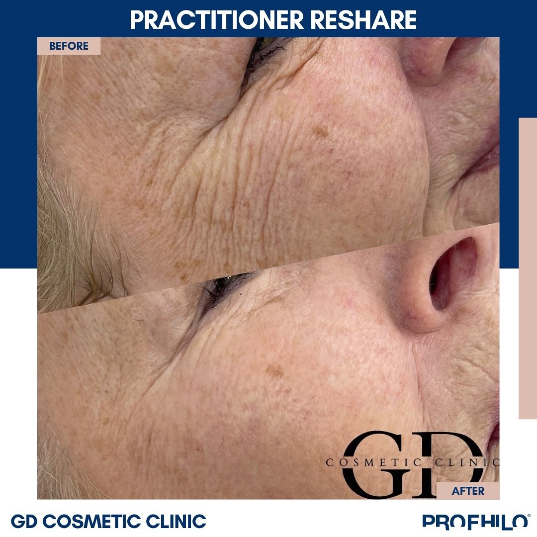 Beautiful Profhilo&reg; results from @gdcosmeticclinic 🌟 Enhanced skin laxity, texture, and quality resulting in a fresh complexion - Discover the art of bioremodelling through the link in bio and find a skilled practitioner near you. ✨

#Profhilo #