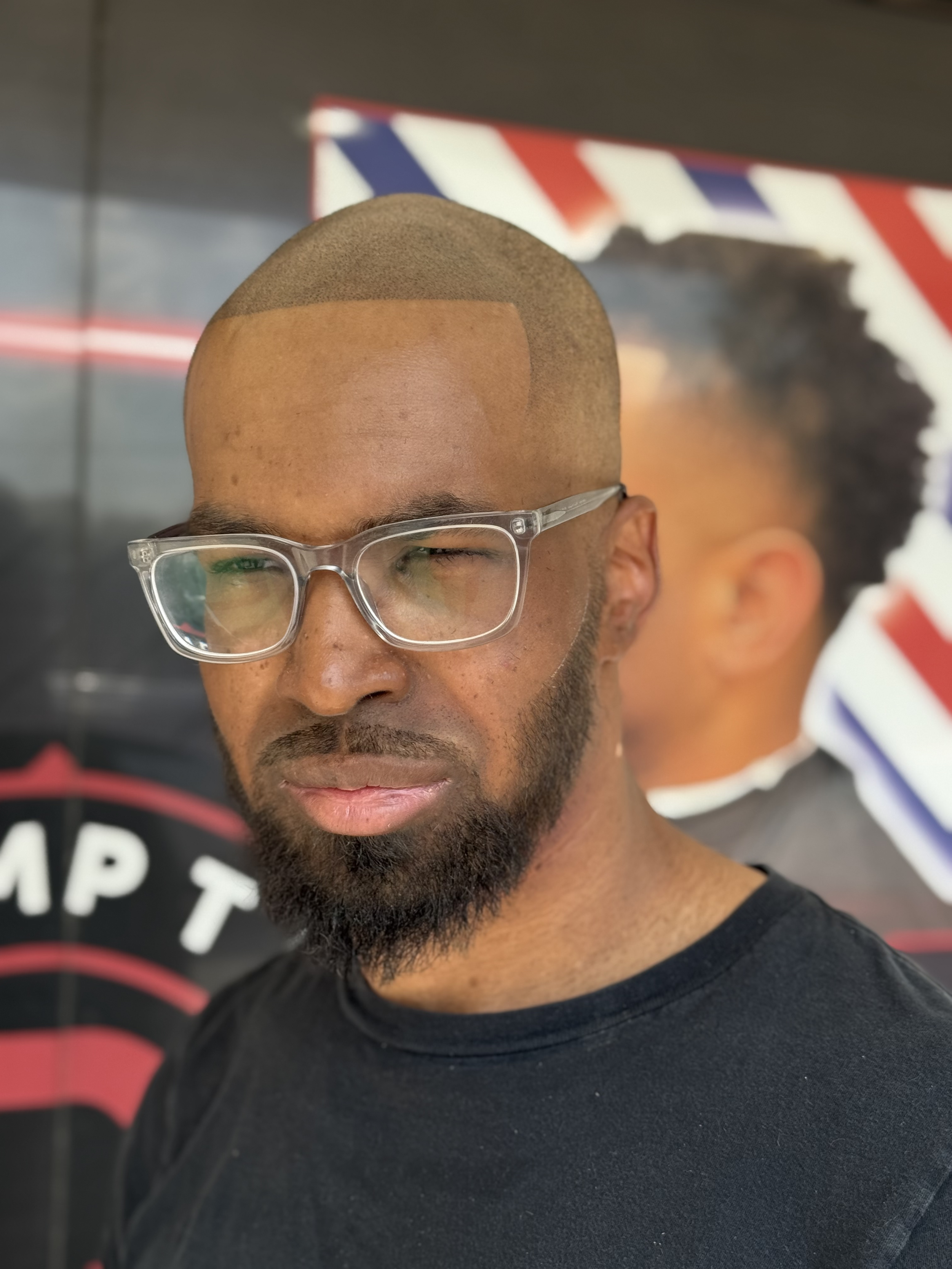 scalp micropigmentation ( SMP) results