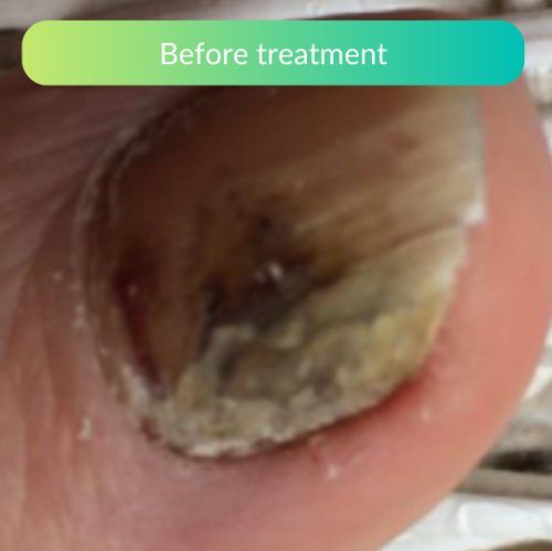 Fungal-Nail-Treatment-At-Home-Clinical-Review-Sam-1.jpg