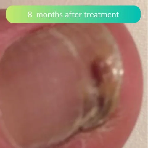 Fungal-Nail-Treatment-At-Home-Clinical-Review-Sam-3.jpg