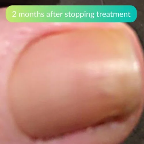 Fungal-Nail-Treatment-At-Home-Clinical-Review-Sam-4.jpg