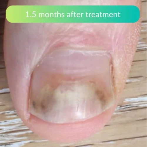 Fungal-Nail-Treatment-At-Home-Clinical-Review-Tony-1.jpg