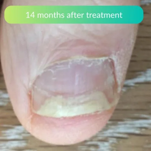 Fungal-Nail-Treatment-At-Home-Clinical-Review-Tony-2.jpg