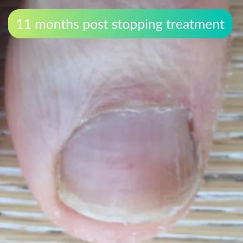 Fungal-Nail-Treatment-At-Home-Clinical-Review-Tony-3.jpg