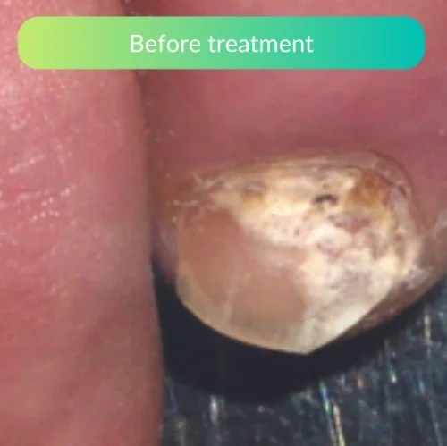 Nail-Fungus-Before-And-After-nailKALM-Zoe-1.jpg