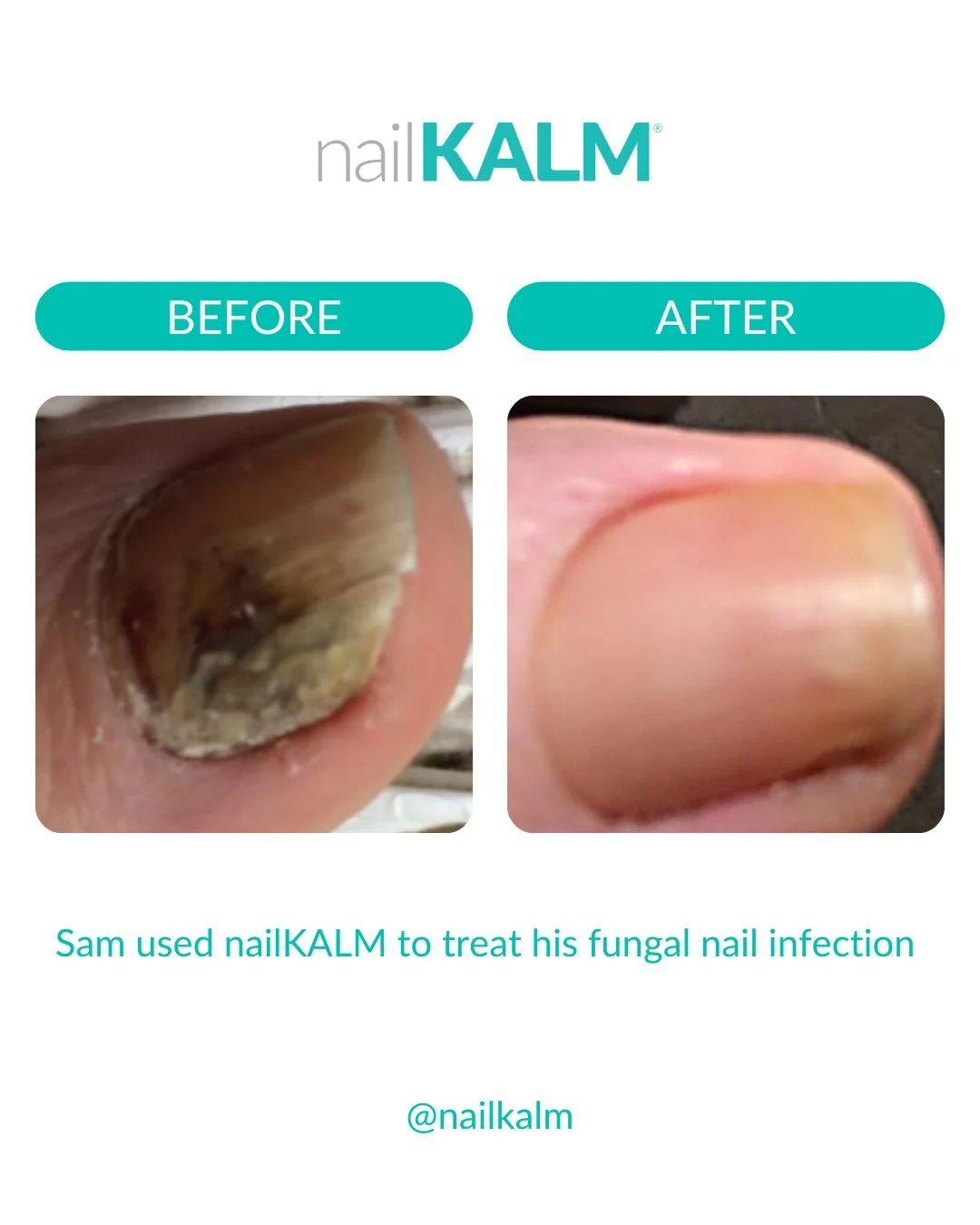 No filters here - just an incredible transformation using #nailKALM

Sam is 50 and has tried to clear his fungal nail infection for 4 years with so many different treatments - all which had failed until nailKALM. 

This is why so many people choose n