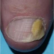 Close-up of a person's toe with a bandage and a yellowish topical treatment applied to the toenail