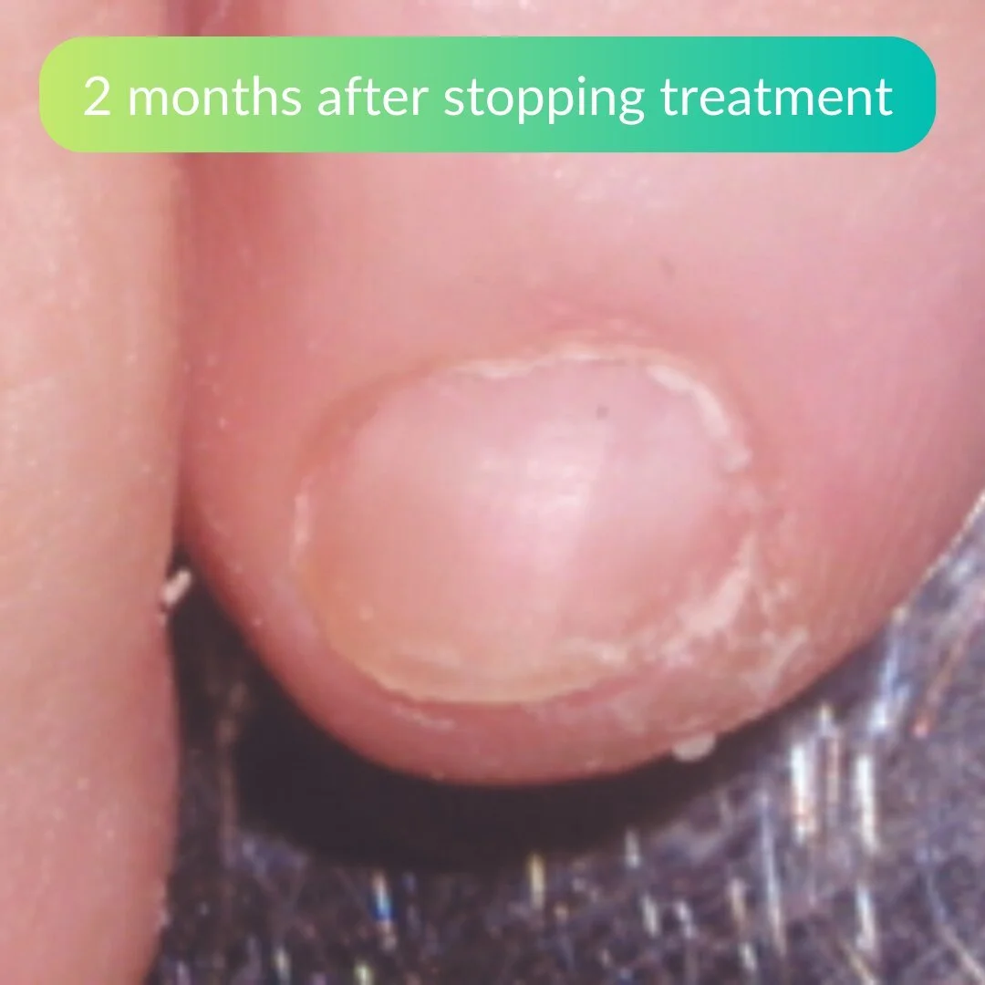A close-up of a fingernail with irregular surface texture, captioned "2 months after stopping treatment."