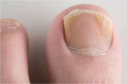 Close-up of a toenail with dry, peeling skin around it.