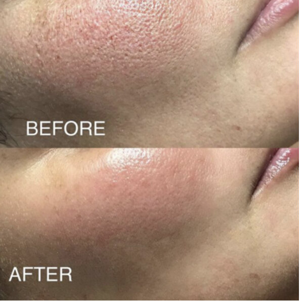 Comparison of skin before and after a skincare treatment Oxygeneo Facial, showing reduced redness and smoother texture in the 'after' image.