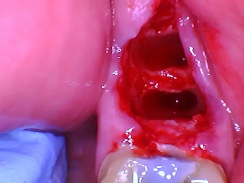 Tooth socket immediately after gentle extraction at Teuscher Legacy Dental