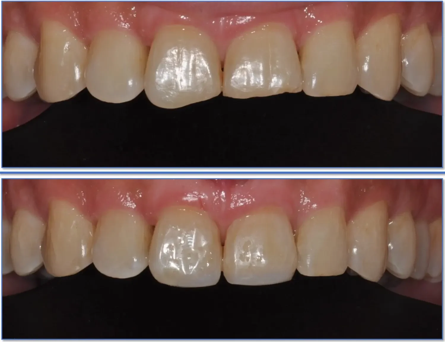 Beautiful Dental Bonding at Teuscher Legacy Dental