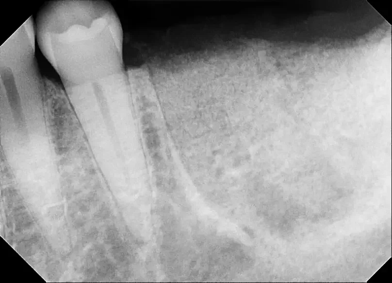 X Ray after extraction and bone graft of #19