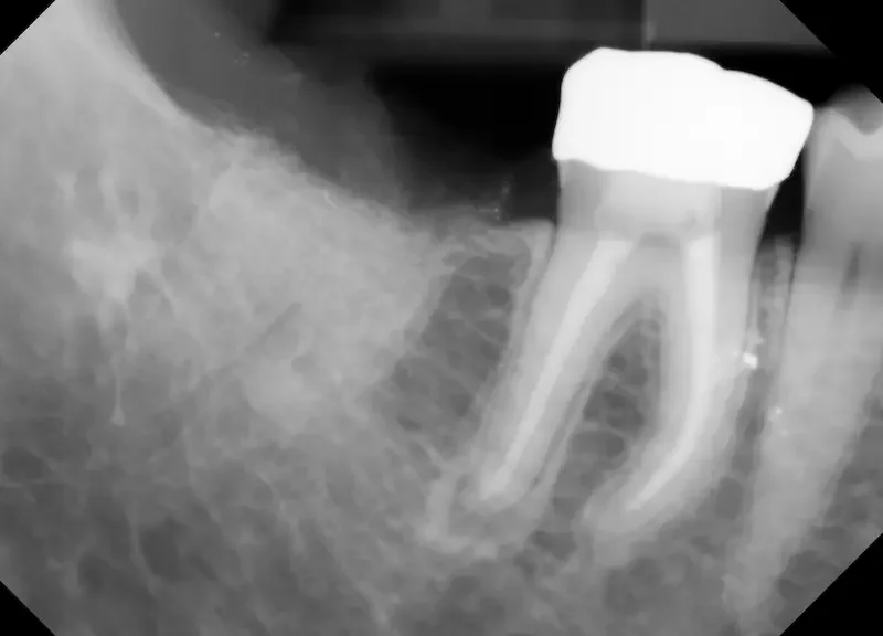 An X-Ray of the extraction site after bone graft placement. You can see how the lighter shade of the grafted particles fills in the space where the tooth roots were before the extraction.