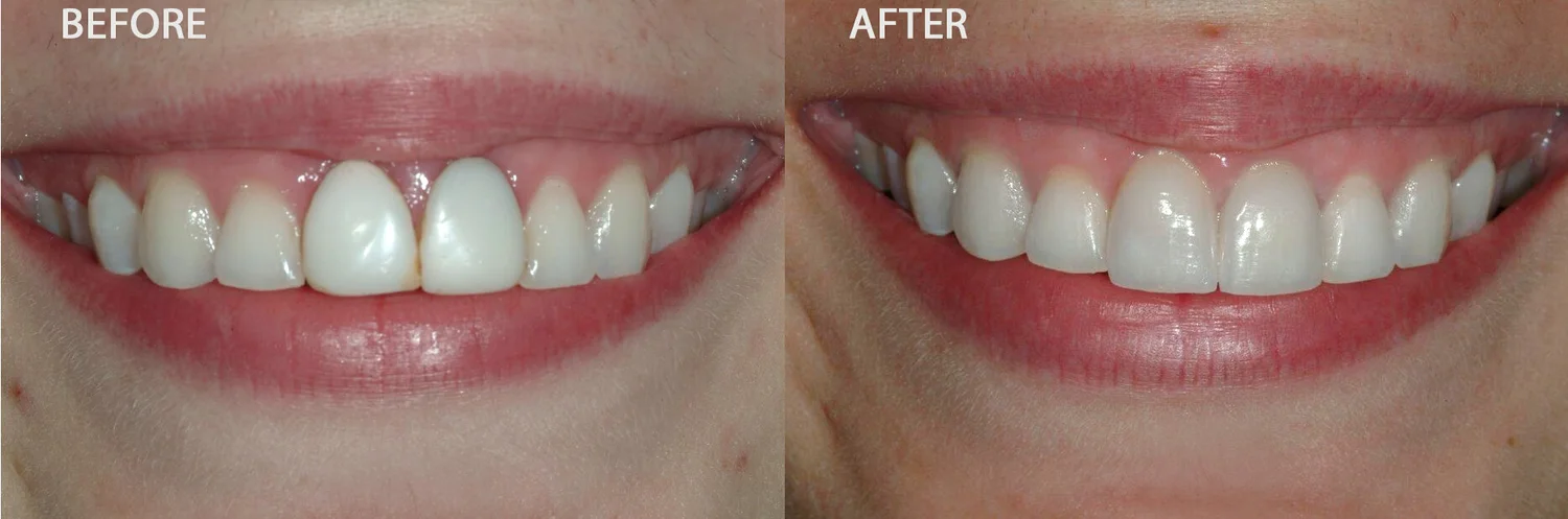 Before and after: old dental bonding replaced with conservative porcelain veneers at Teuscher Legacy Dental
