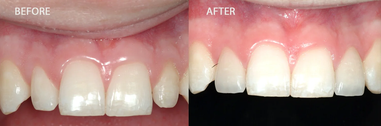 Before and after: undersized peg lateral incisors corrected with porcelain veneers after orthodontics
