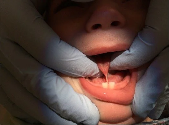 Dr Ghaheri tongue tie.jpg