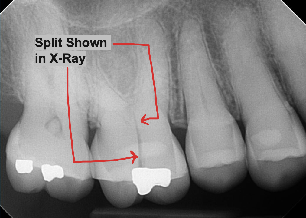 Cracked Tooth X Ray Year 3