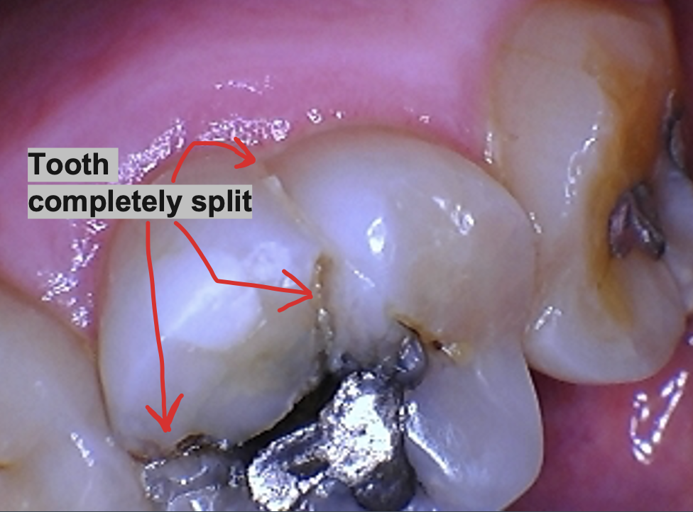 Cracked Tooth Year 3