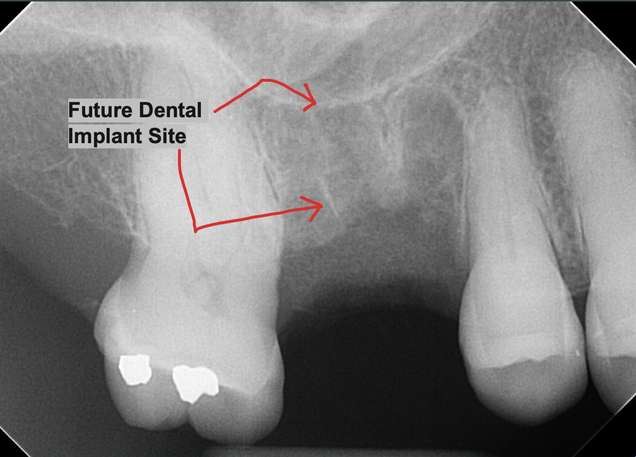 Split Tooth Extracted