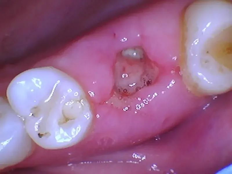 6 Days After Tooth Extraction and Bone Graft — What’s Normal?