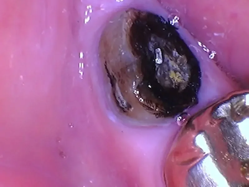 A lower right molar crown fell out. The darkness is mostly stain, but there are small areas of decay that likely contributed to the crown loosening. The tongue side of the remaining tooth is flush with the gums.
