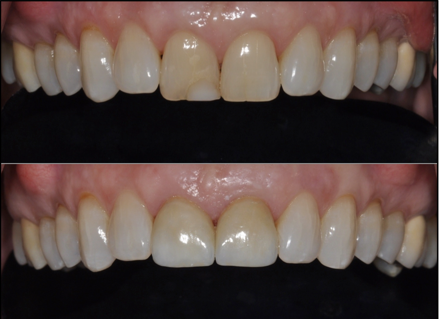 Before and after: Sally's two front teeth restored with custom porcelain in time for her wedding at Teuscher Legacy Dental