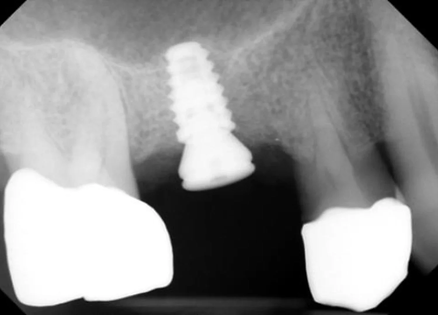 Not Enough Bone for an Upper Implant? A Real Sinus Lift Case, Start to Finish