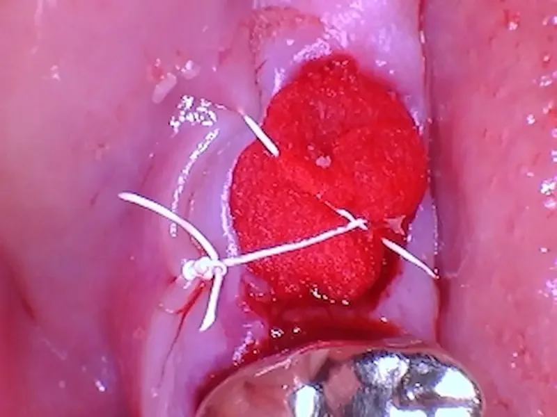A photo of the grafted site. The red part is the collagen plug over the top of the particle graft. In this case one figure 8 suture was enough to keep everything stable for healing.