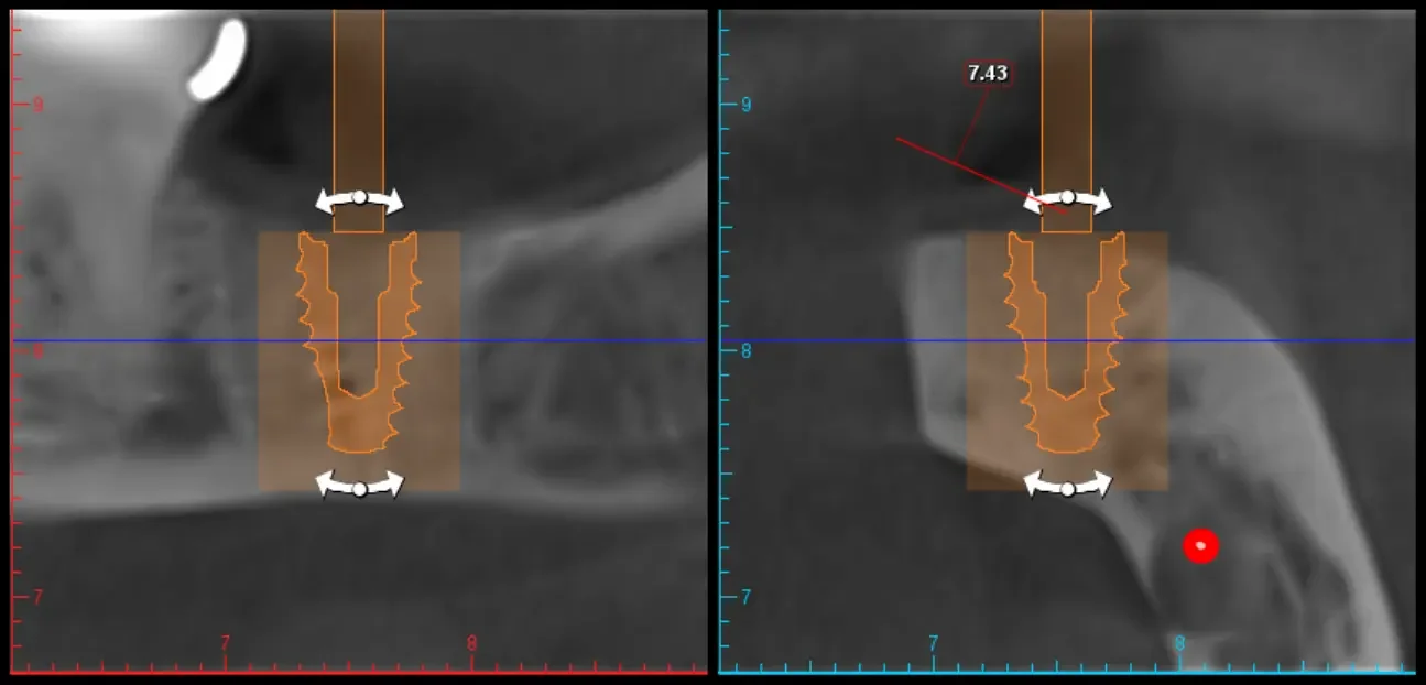 Dental Implant Planning to avoid nerve space in St Charles, IL