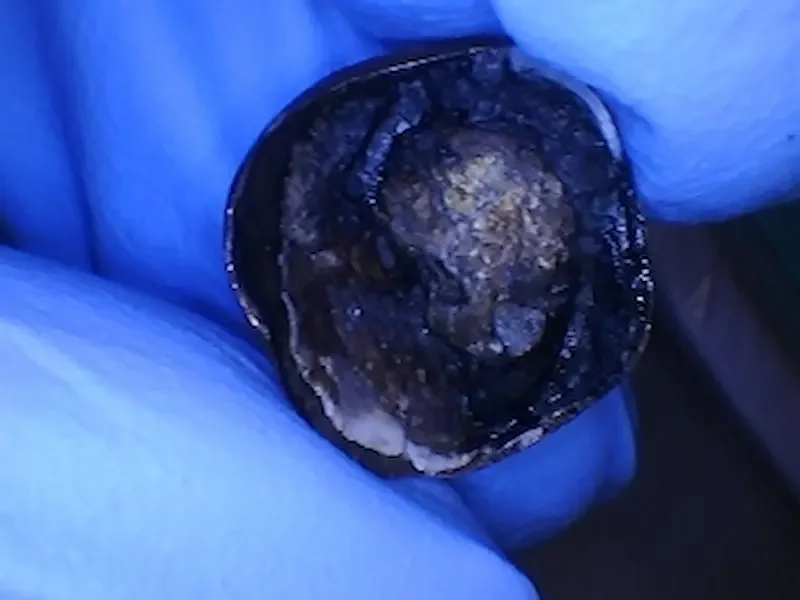 Root Canal Treated Lower Molar Tooth before Extraction crown fell off