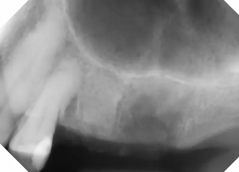 X ray after extraction and bone graft
