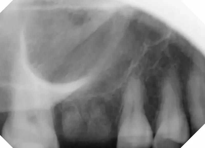 Extraction and socket preservation bone graft X Ray