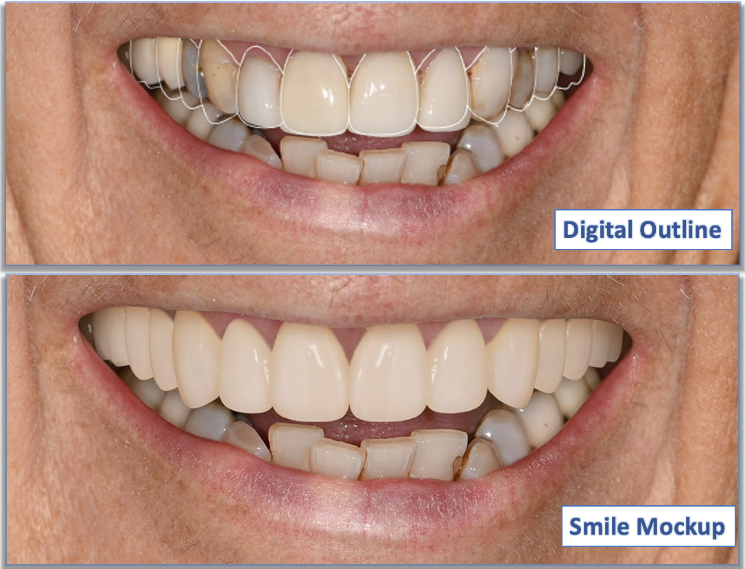 Digital Smile Design preview showing a patient's future smile before treatment at Teuscher Legacy Dental