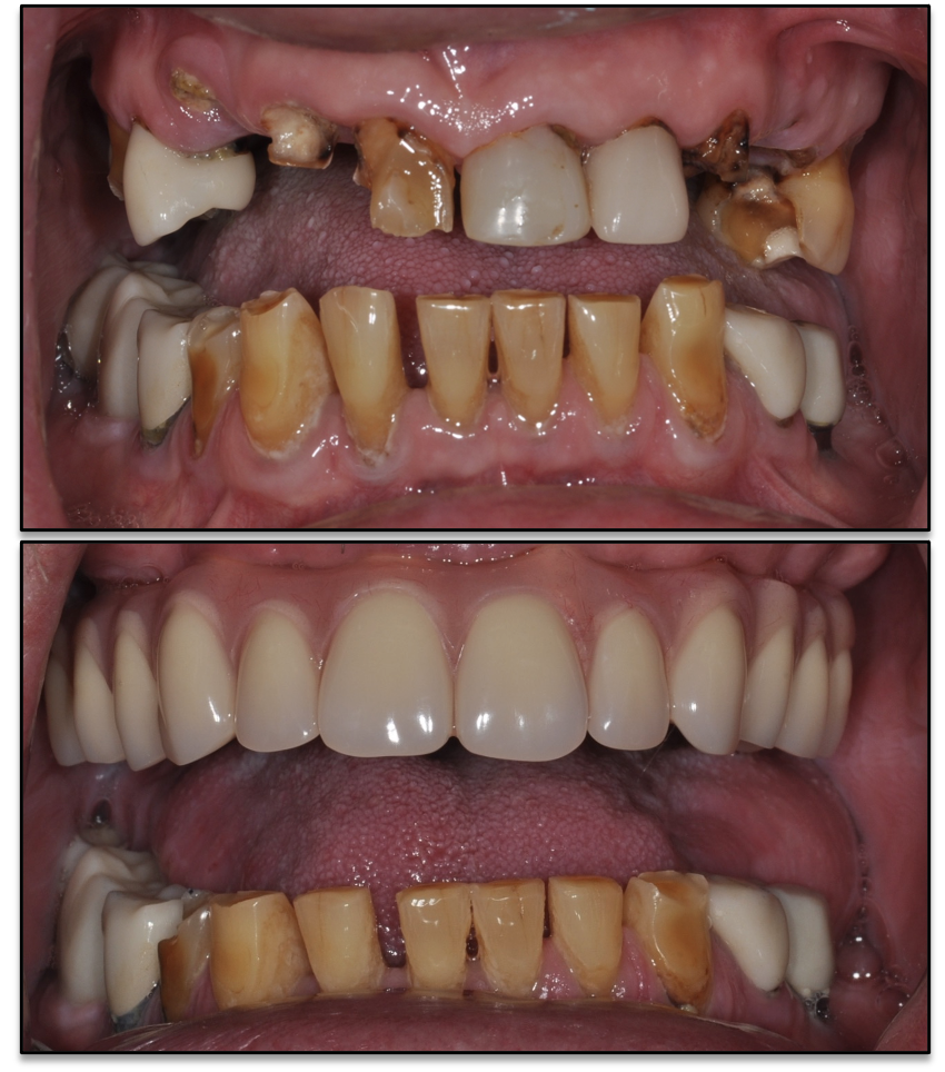 Before and after: fixed implant-supported denture smile transformation for a Kane County business owner