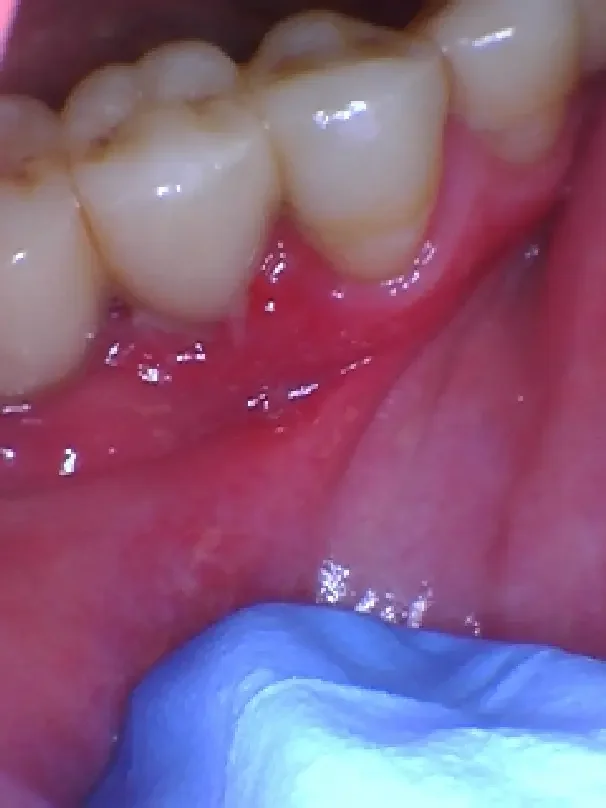 Irritated gums from popcorn kernel