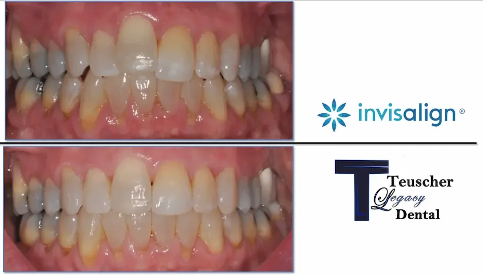 Orthodontics for cosmetic dentistry at Teuscher Legacy Dental