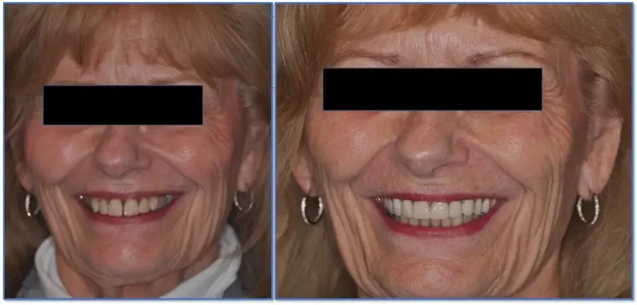 Upper Arch Cosmetic Veneers at Teuscher Legacy Dental