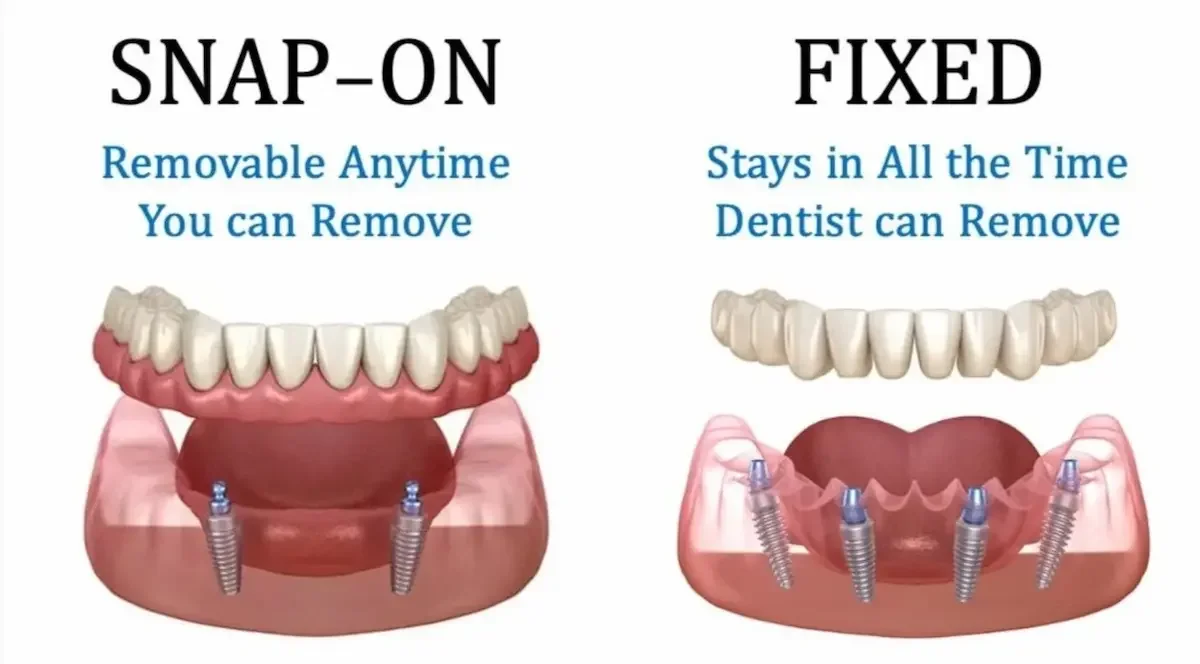 Snap on versus Fixed (All-On-4) Implant supported dentures