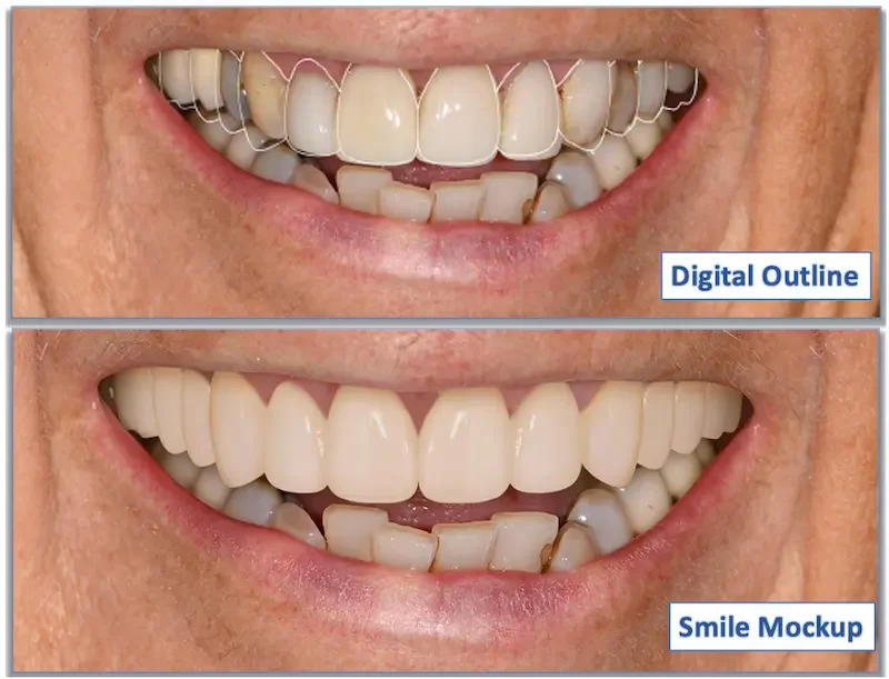 Digital Smile Design at Teuscher Legacy Dental