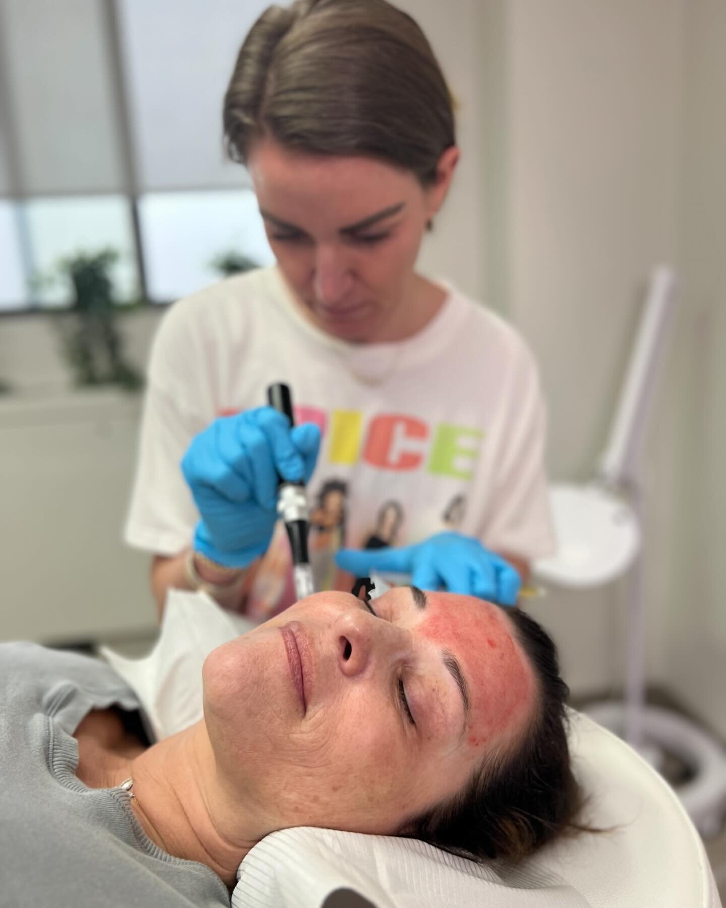 Fun fact: 1 microneedling treatment a year yields the same amount of collagen we lose a year. 

It&rsquo;s like hitting pause on aging and hitting rewind for youthful skin! ✨

The science and everything you need to know about microneedling and PRP is