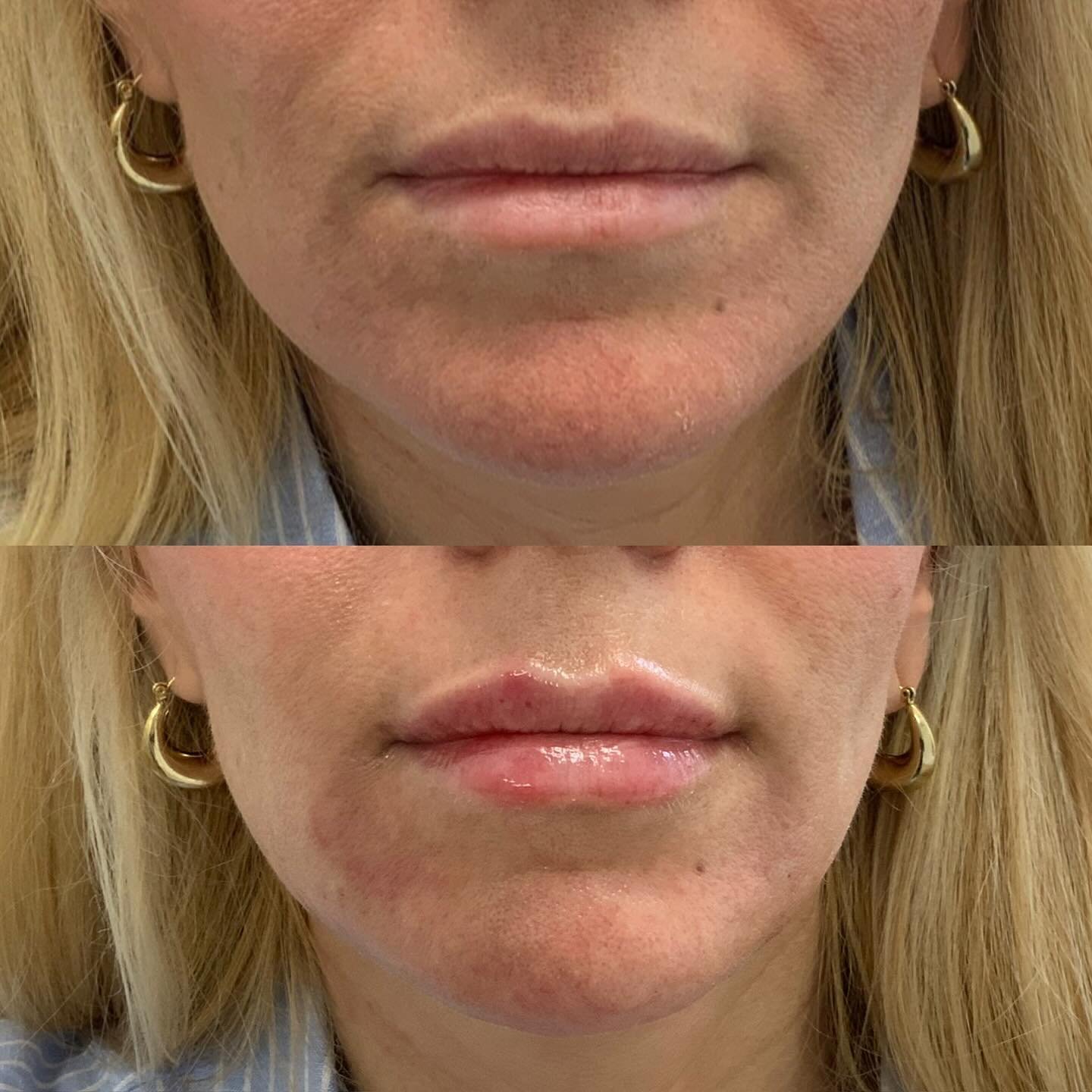 Lip filler perfection from all angles. ✨ 

This is a great example of how a &lsquo;little&rsquo; can go a long way - accentuating her natural lip shape, adding hydration, and subtle volume with just 1 session of lip filler. 

link in bio to get on ou