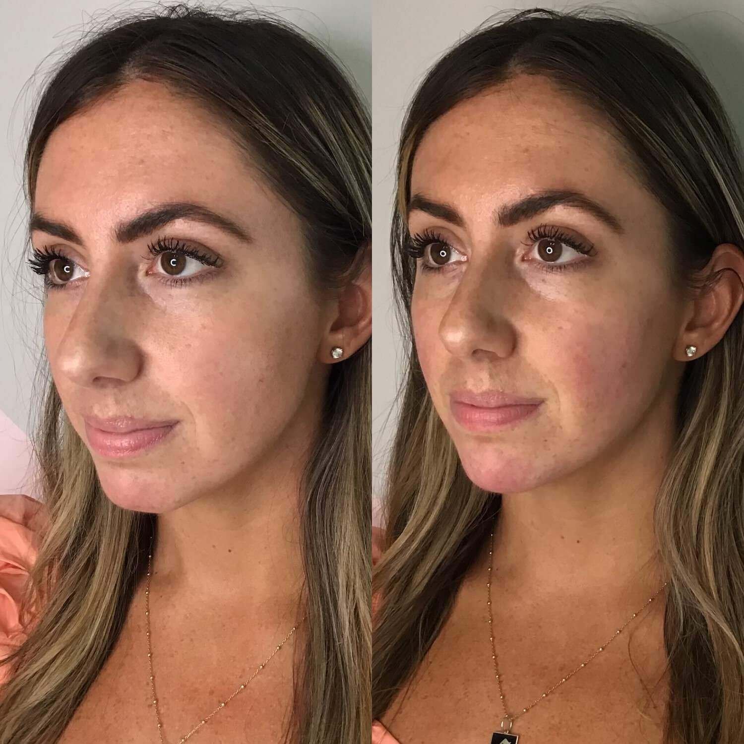 dermal and lip injections bethesda - before and after