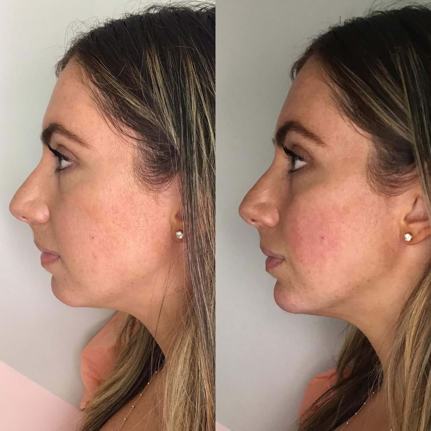 dermal and lip injections bethesda - before and after