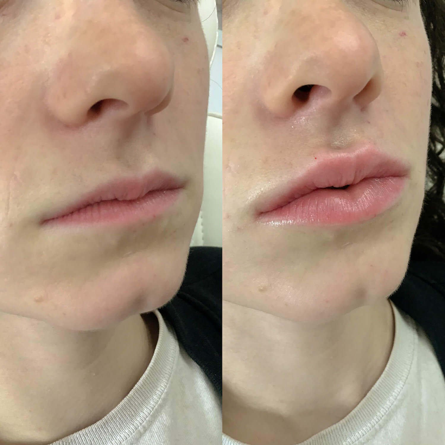 dermal and lip injections bethesda - before and after